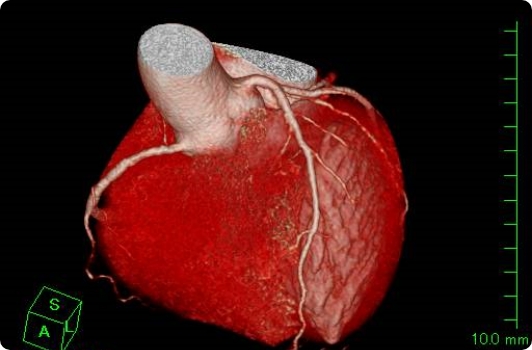 冠動脈造影CT