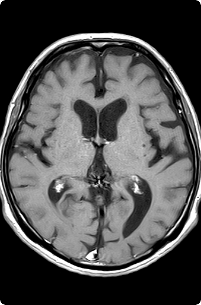 頭部造影MRI
